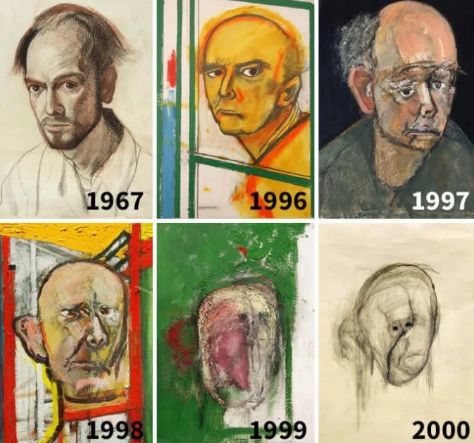 Utermohlen: Alzheimer → körvonalak eltűnése, arctalanodás